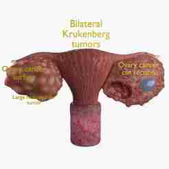 Krukenberg ovarian cancer tumor